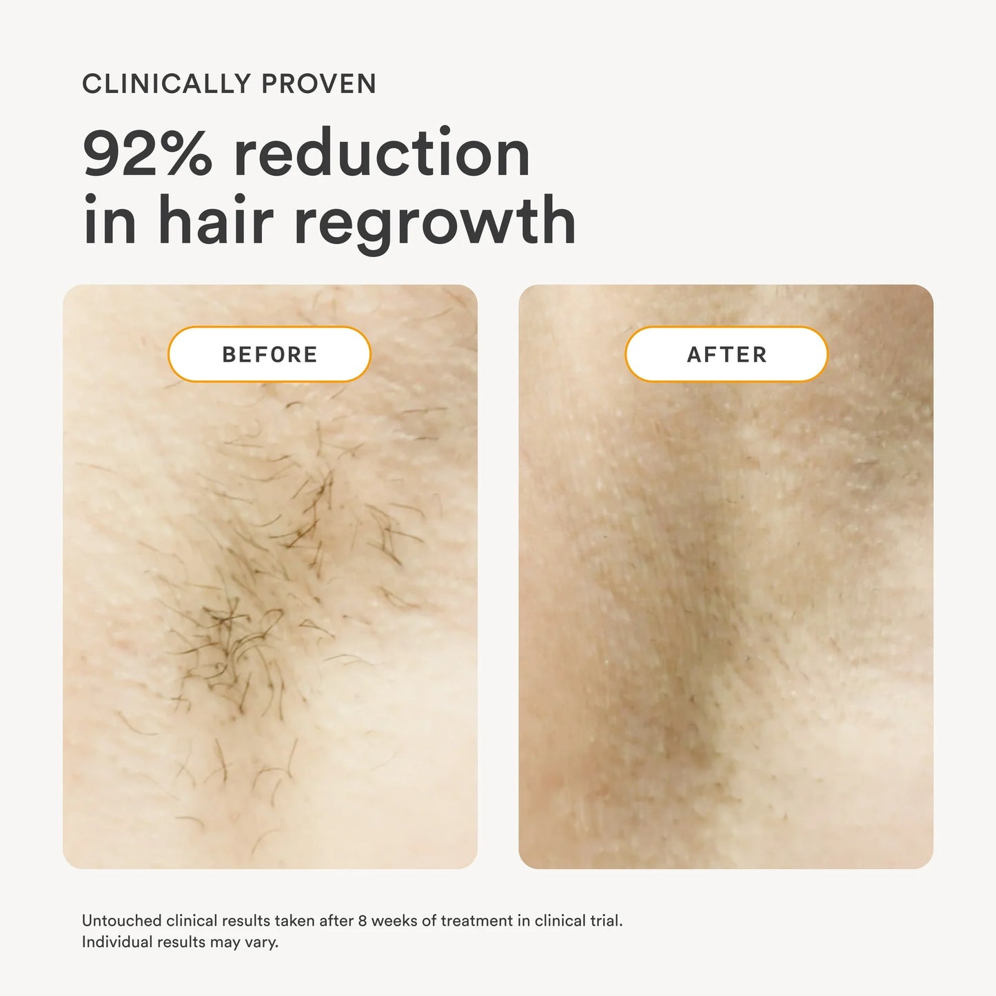 Nood Flasher 2.0 — IPL Laser Hair Removal Device for Women & Men — Pain-Free & Permanent Results