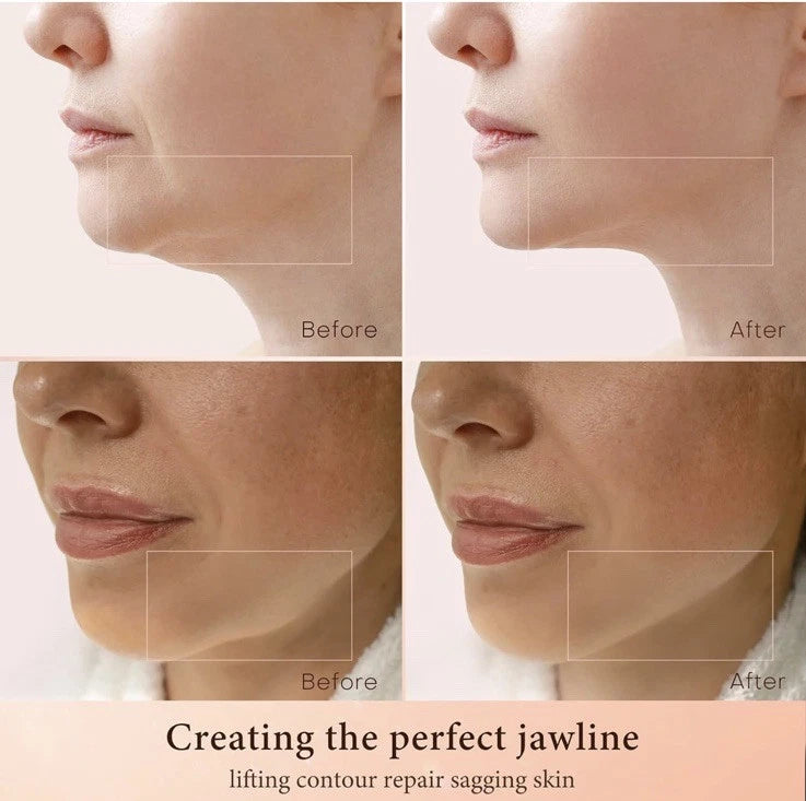 Radio Frequency Skin Tightening Device, Professional 10 Watt, Reduce Wrinkles