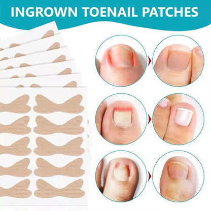 SEFUDUN 120pcs Ingrown Toenail Patches Discomfort Relieving Inflammation Prevent