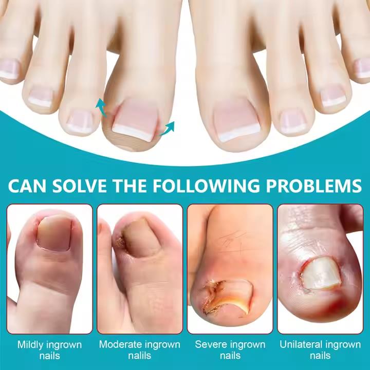 SEFUDUN 120pcs Ingrown Toenail Patches Discomfort Relieving Inflammation Prevent