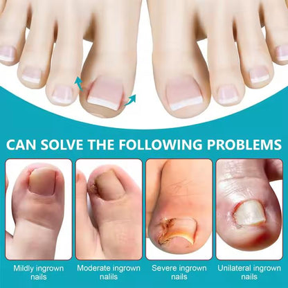 SEFUDUN 120pcs Ingrown Toenail Patches Discomfort Relieving Inflammation Prevent