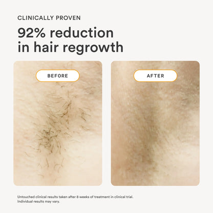 Nood Flasher 2.0 — IPL Laser Hair Removal Device for Women & Men — Pain-Free & Permanent Results